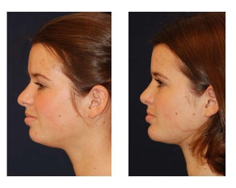 Chin Lipo 346991