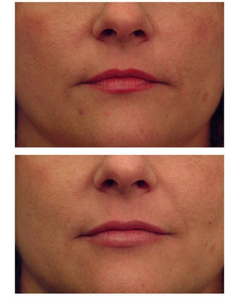 Injectable Filler before 301192