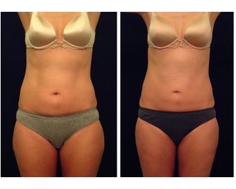 Liposuction before 397032