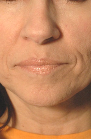 Juvederm for Mouth Rejuvenation before 204763