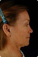 Face and neck lift 6744