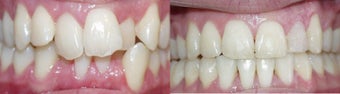 Before and after orthodontic treatment before 300717