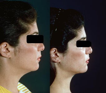 Chin and Neck Liposuction before 449933