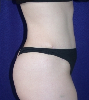 Tummy Tuck (abdominoplasty) 208463