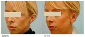Otoplasty (Cosmetic Ear Pinning) before 136394
