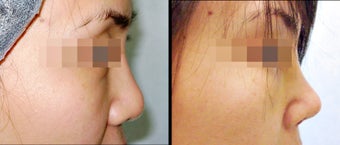 Rhinoplasty before 650739