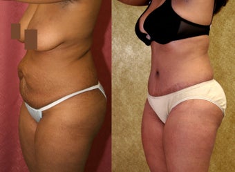 tummy tuck 304680