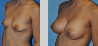 Flash Recovery Breast Augmentation TM before 253883