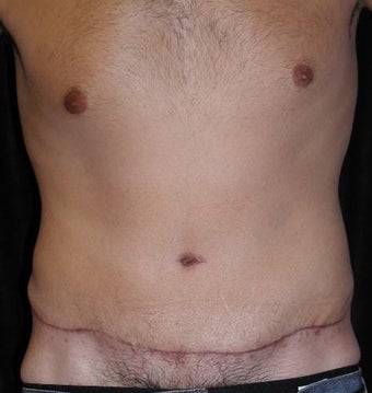 Male tummy Tuck, Flank Liposuction after 578169