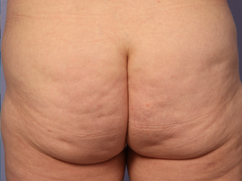 Cellulaze after 607911