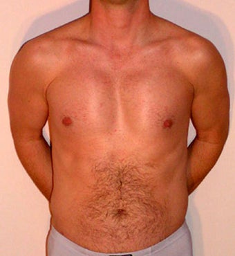 Male Chest Enhancement after 525476