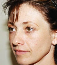 blepharoplasty (eyelids) after 219358
