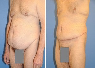Abdominoplasty before 356410
