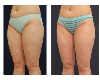 Liposuction after 392328