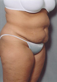 Tummy Tuck 428193