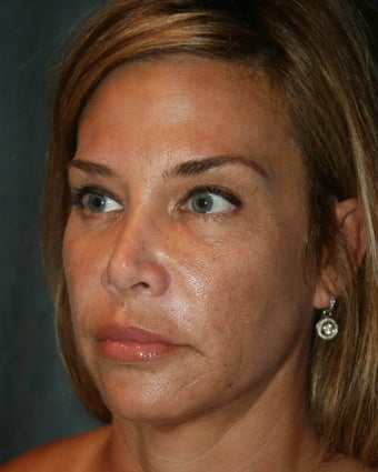 Ultherapy 499168