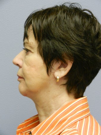 Lower Face Neck Lift 574541