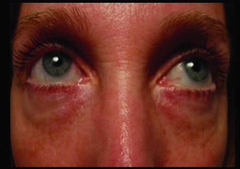 Radiesse under the eyes before 349881
