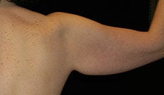 Arm Lift before 608997