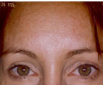 Botox after 469280