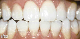 Tetracycline after 234635