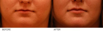 Lip Augmentation before 220460