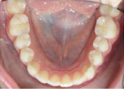 Invisalign 24 Months Severe Over Jet and Tongue Thrust 349090