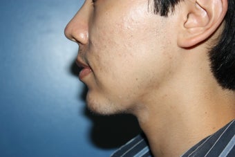 Chin augmentation after 546575