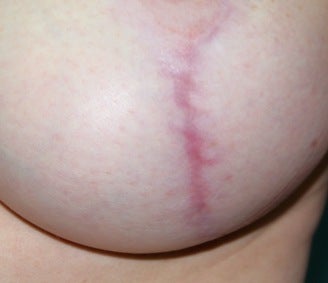 Laser for breast implant scar before 376099