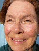 Skin Resurfacing Using Plasma Rejuvenation with Portrait after 196054