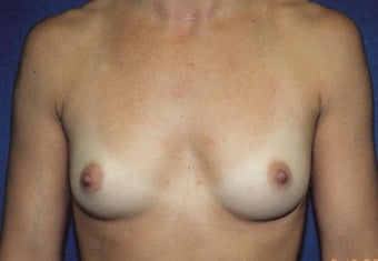 Breast Augmentation before 266795