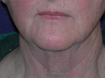 Necklift before 208439