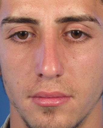 Rhinoplasty after 400983