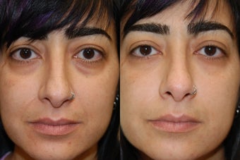 Silikon-1000, Injectable Filler treatment for lower eyelid "bags" and naso-labial folds. before 145620