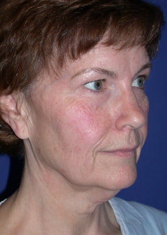 Facelift before 456919