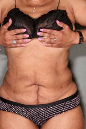 SmartLipo™ after 529445