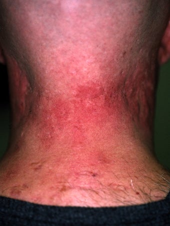Acne Scarring before 417355