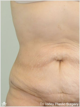 Liposuction after 420933