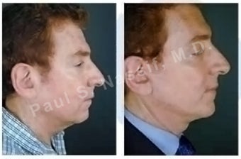 Lower Face and Neck Lift before 138179