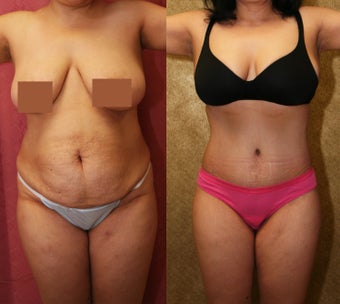 tummy tuck before 304704