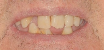 Dental implants, all porcelain restorations before 503146