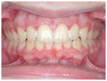 Deep Overbite Correction after 420138