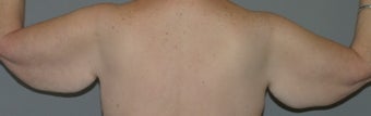 Arm-lift, Brachioplasty 564065