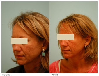 Acne Scarring Correction before 136805