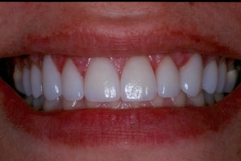 Upper Porcelain Veneers and Porcelain Crowns 370566