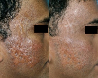 Fraxel Restore treatment of Facial Scars before 131005