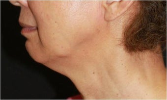 Ultherapy before 421635