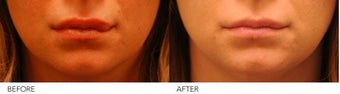Lip Reduction before 245414