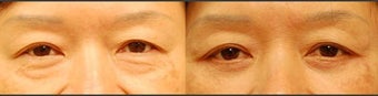 Lower Eyelid Surgery before 454039