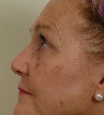 Pearl Laser Treatment before 102778
